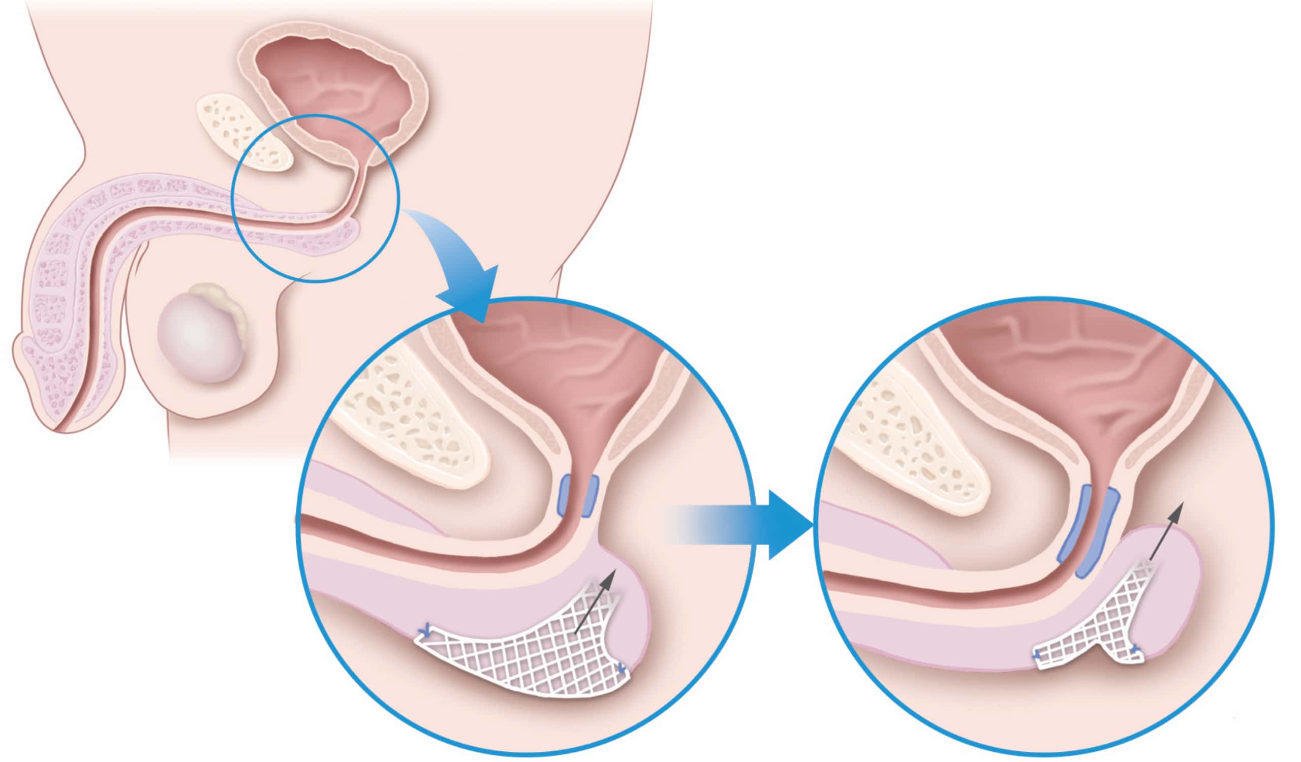 male incontinence